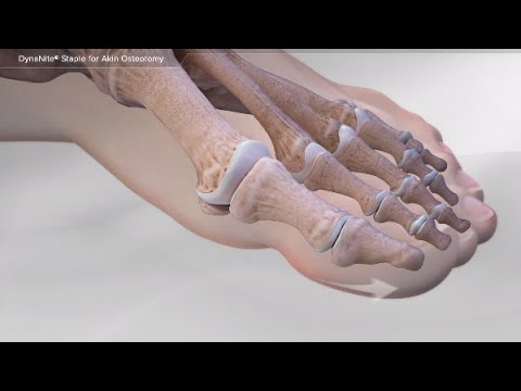 Cpt Code Akin Osteotomy