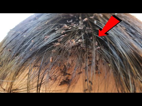 Big lice combing on short hair boy - Giant Lice Removal