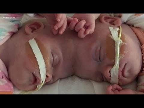 Doctors describe detail it took to separate formerly conjoined NC twins