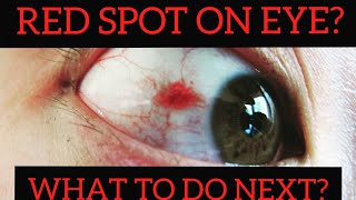 RED SPOT ON YOUR EYE| WHAT TO DO NEXT? | VINOD EYE CENTRE