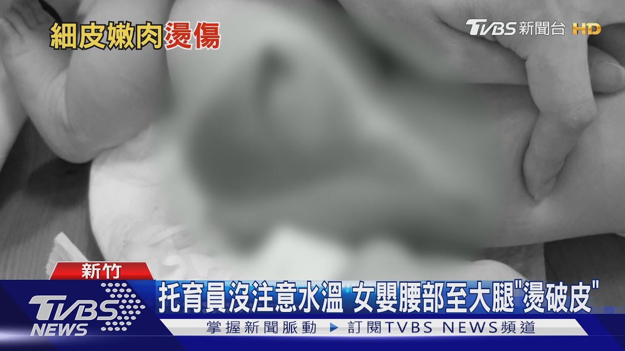 痛!托嬰員洗澡不慎 7月大女嬰臀腿2度燙傷