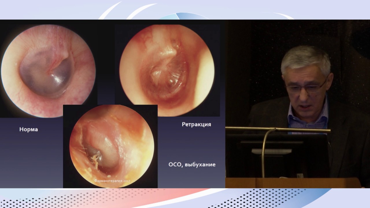 2 Острый и рецидивирующий средний отит.