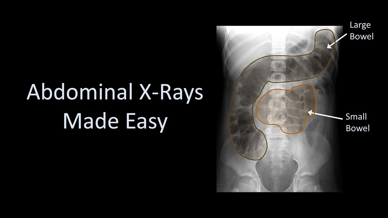 Abdominal X-Rays Made Easy