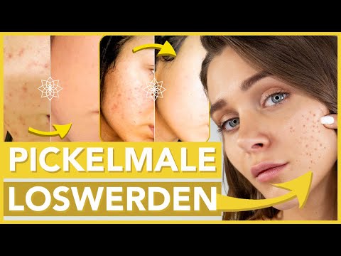 Pickelmale - Einfach und schmerzfrei zuhause selbst entfernen
