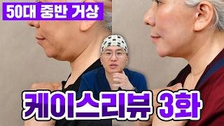 50대 중반 안면거상, 수술 전후 이렇게 달라졌습니다 | 실제 케이스 분석