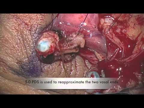 Vasectomy Reversal - Vasovasostomy
