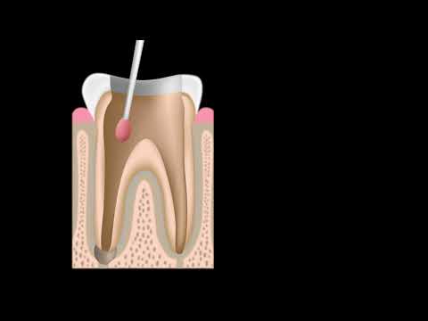 Video showing how root canal therapy works
