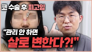 코수술 결과를 좌우하는 부기·피고임 관리, 이렇게 해야 합니다!