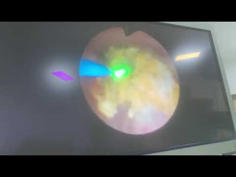 RIRS LASER STONE FRAGMENTATION