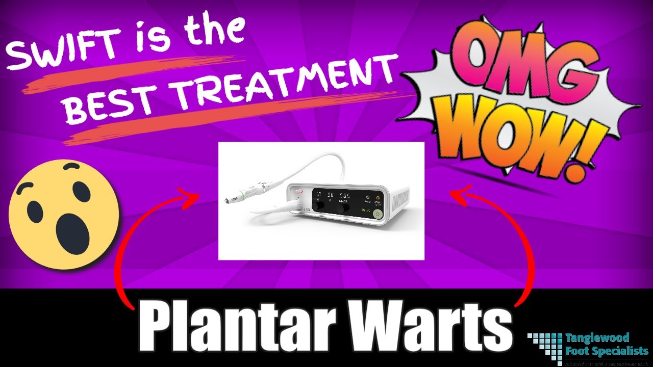Swift is the Best Treatment for Plantar Warts