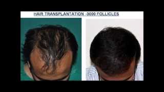 preview picture of video 'Kerala- Hair transplantation results'