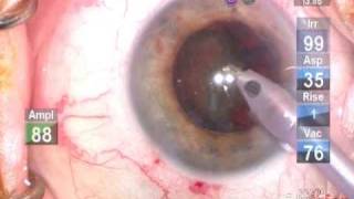 Cataract Extraction (flip-chop technique)