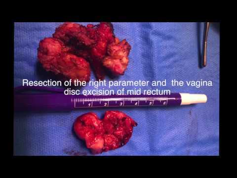 Huge deep endometriosis involving sacral roots and mid rectum
