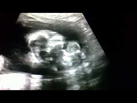 Tvillingarna vecka 19+6 ultraljud / Twins ultrasound week 19+6
