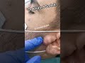Ear We Go Again Skincare Pimplepopping Blackheadremoval Dr Khaled Sadek