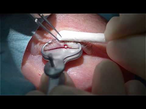 Eyelid Surgery - Dr. H. Aral - Targeted Eyelash Bulb Excision. KAI Medical Biopsy Punch.