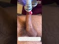 Penis Shockwave Therapy For Harder Erections