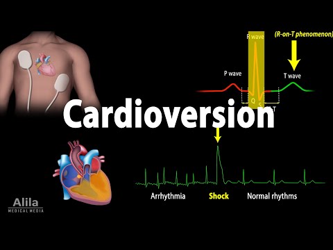Cardioversion (Electrical) Procedure, Animation