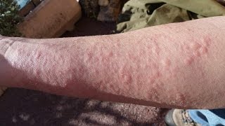 Home Remedies for Hives | Allergic reaction hives