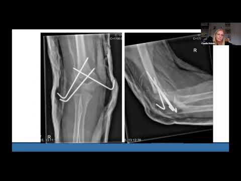 Fundamentals of Orthopaedics Session 6: Paediatrics Session 1 - Supracondylar Fractures and NAI