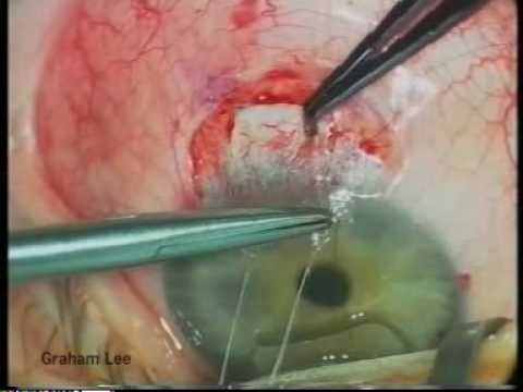 Glaucoma Surgery