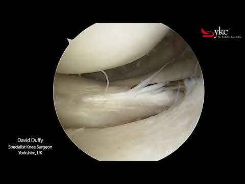 Watch a Knee Surgeon Treat a Meniscal Tear