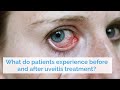 What do patients experience before and after uveitis treatment?