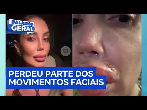 Mulher fica com lábios inchados e dentes quebrados após fazer procedimento estético com dentista