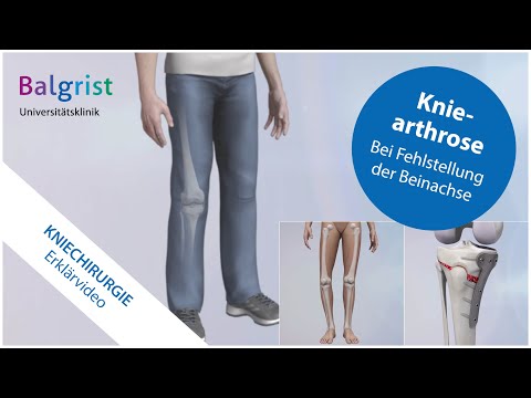 Correction of leg axis in knee osteoarthritis