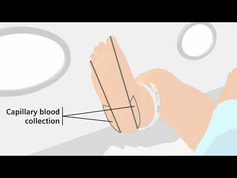 How to properly handle a capillary blood gas sample Video