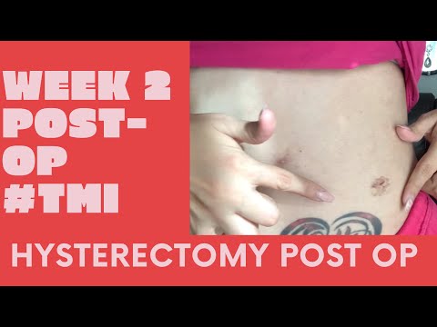 Laparoscopic Hysterectomy Surgery WEEK 2 POST OP | TMI