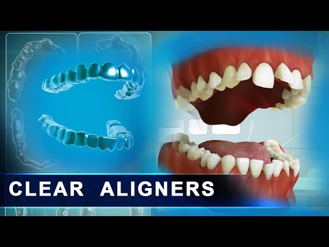How Clear Aligners work - step by step Orthodontics guide in 3d Animation | Medical Dental Animation