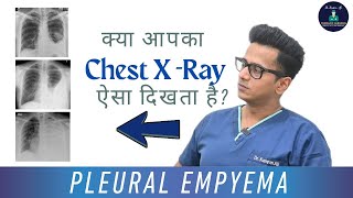 Pleural Empyema: The infection That Fills Your Chest With Pus