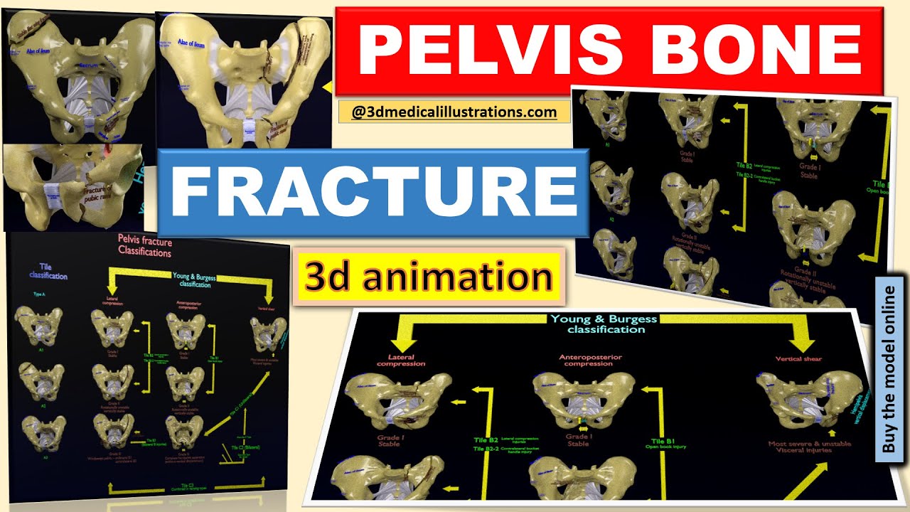 Fraturas da pelve Modelo 3D