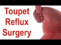 Toupet Fundoplication or 270° Stomach Wrap to Treat Reflux