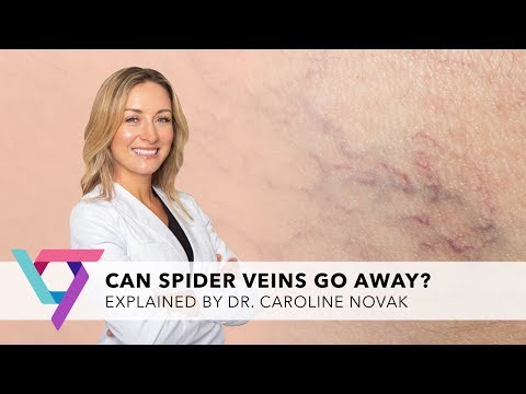 Medical Clinic: Can Spider Veins Go Away? | Vein Treatment Center Manhattan 10016