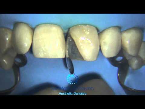 Direct Anterior Restorations