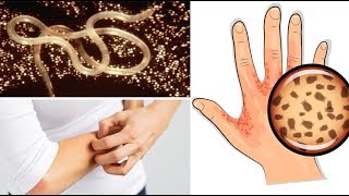 Everyone Should Watch Out For These 8 Signs of Parasitic Infection!