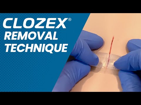 Clozex Removal Technique