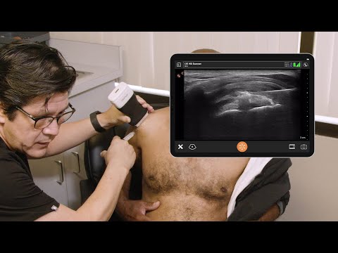 Subacromial Bursa Injection - Ultrasound Scanning Technique