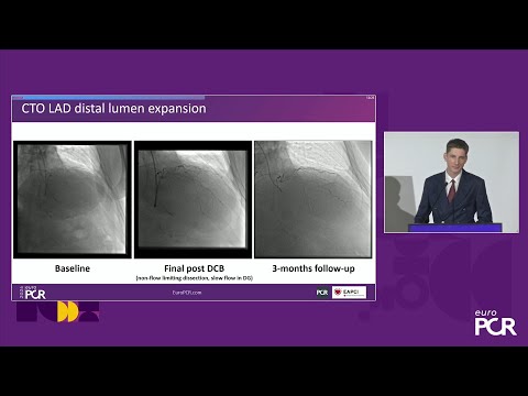 Mastering the future of PCI with drug-coated balloons - EuroPCR 2024