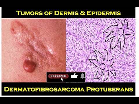 8n - Dermatofibrosarcoma Protuberans