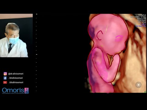 Gestação 20 semanas.