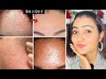 मुश्किल से मुश्किल Tiny Bumps White Bumps सफ़ेद दान�