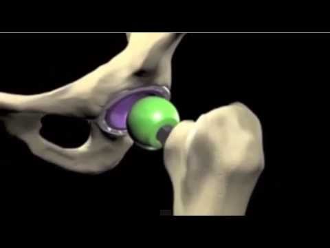Conseguenze di un braccio rotto al gomito Ginnastica colonna vertebrale cervicale in video