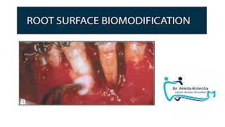 ROOT SURFACE BIOMODIFICATION for root coverage| Additive treatment| Root coverage| DR. ANKITA