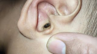 BIGGEST EARWAX REMOVAL | Huge Ear Wax Finally Removed After 10 Years