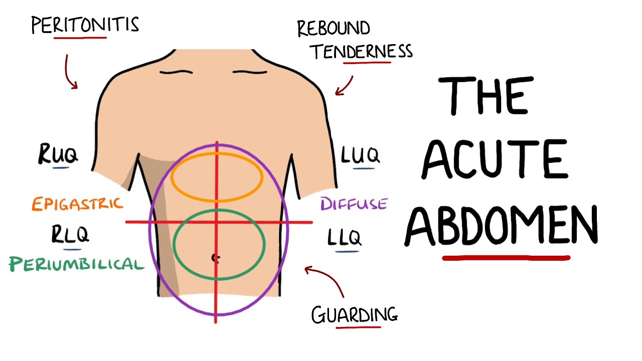 Acute Abdomen - A Guide to Acute Abdominal Pain