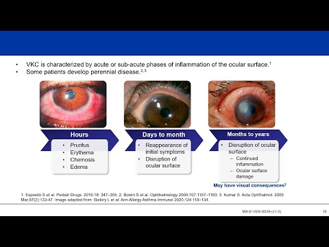 Understanding Vernal Keratoconjunctivitis (VKC): Not “Just an Allergy”