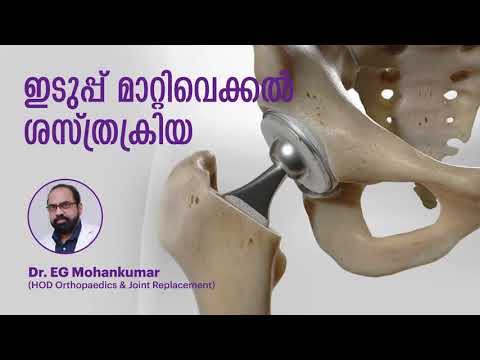 ഇടുപ്പ് മാറ്റിവെക്കൽ ശസ്ത്രക്രിയ